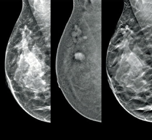 Hologic I-View™ Contrast Enhanced Imaging