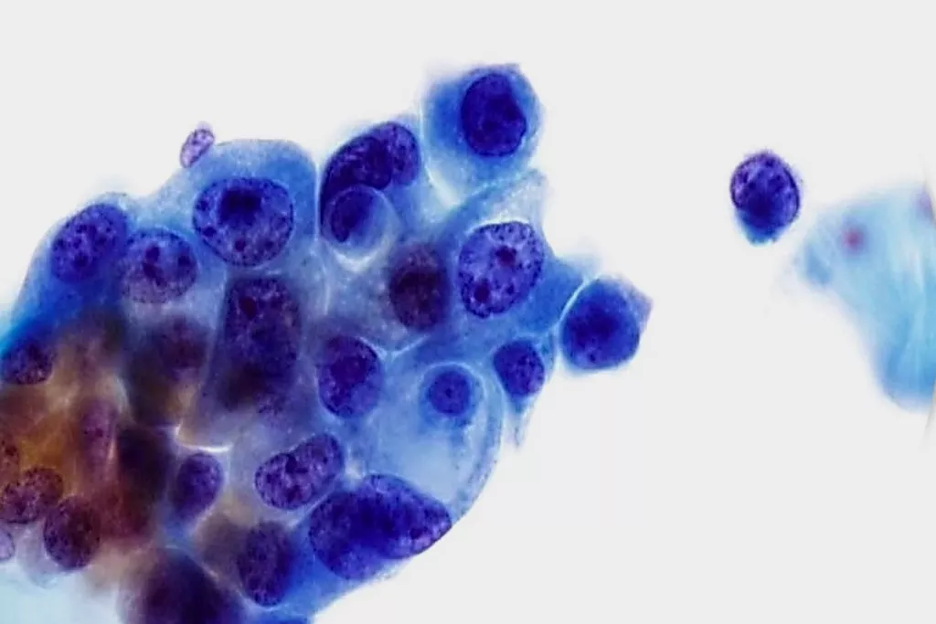 urothelialt carcinoma, grad 3, urin, PAP farvning